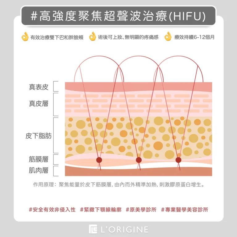 高強度聚焦超音波治療