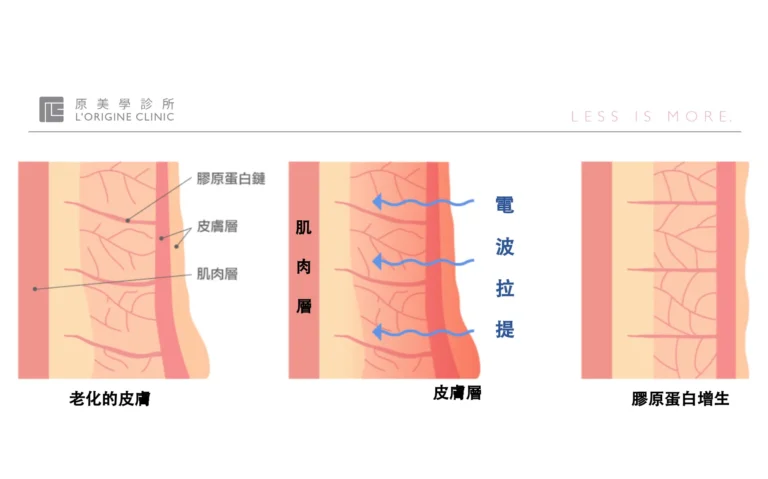 鳳凰電波推薦用熱能緊膚除皺