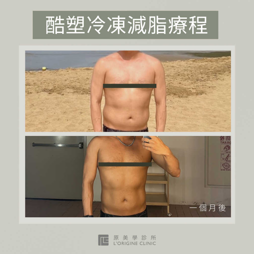 酷塑冷凍減脂醫美推薦診所