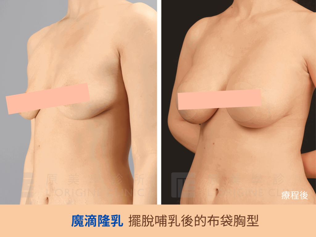 產後胸型走針 產後哺乳 產後胸部鬆弛 布袋奶 隆乳 魔滴隆乳