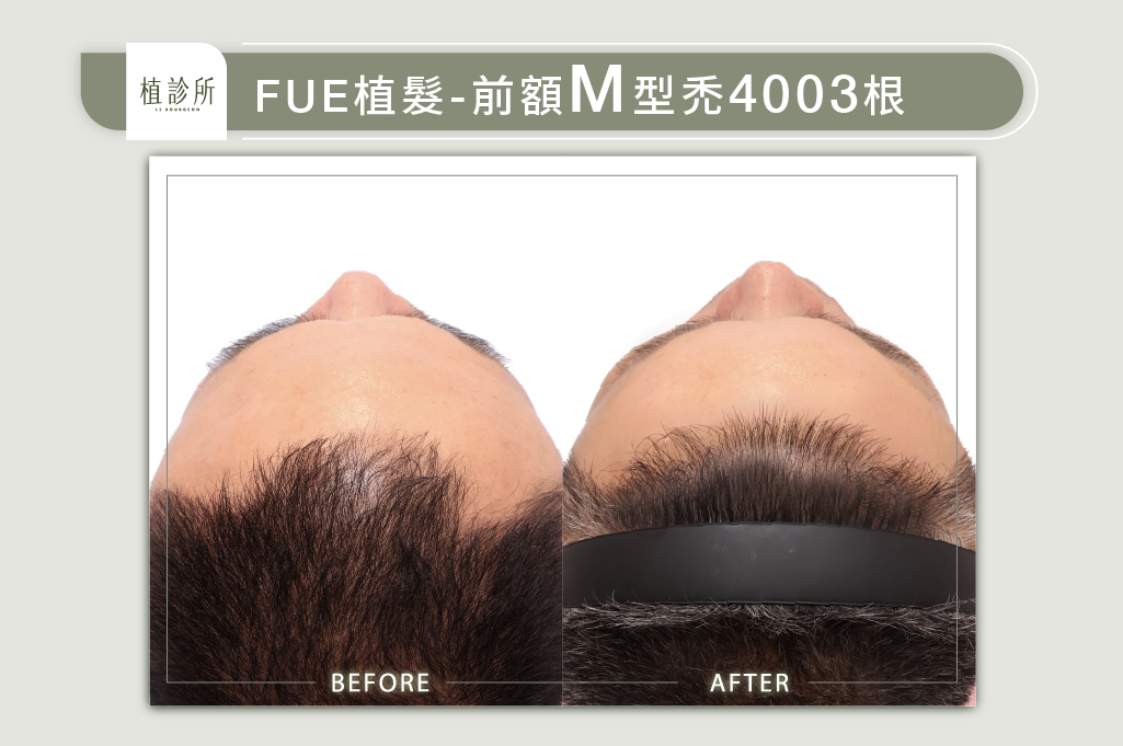 官網陳燕萍醫生案例圖-何松豫1jpg