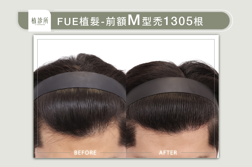 官網陳燕萍醫生案例圖-李偉綸1