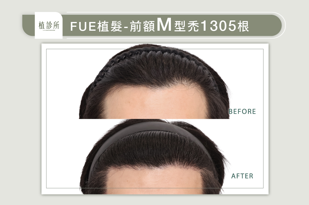 官網陳燕萍醫生案例圖-李偉綸2