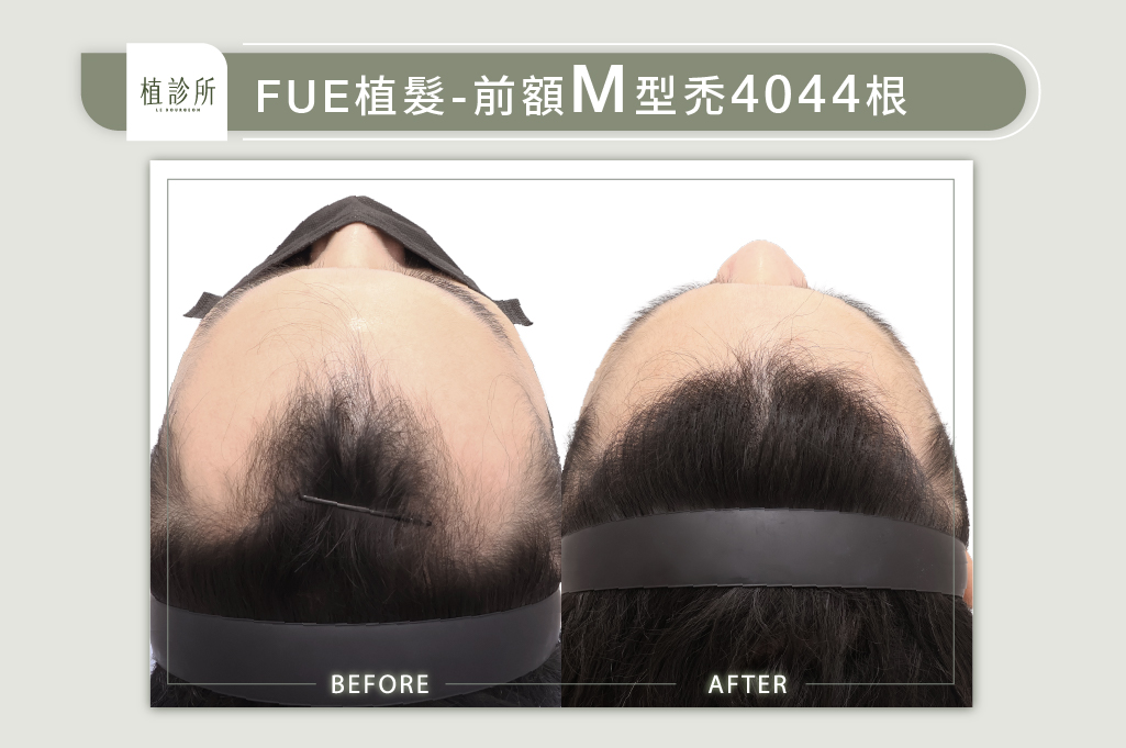 官網陳燕萍醫生案例圖-江睿銓1