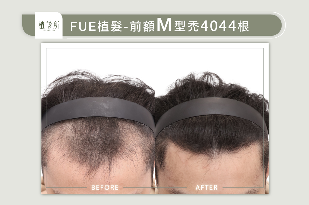 官網陳燕萍醫生案例圖-江睿銓2