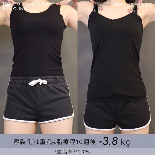 減重案例-BA-婷婷_0